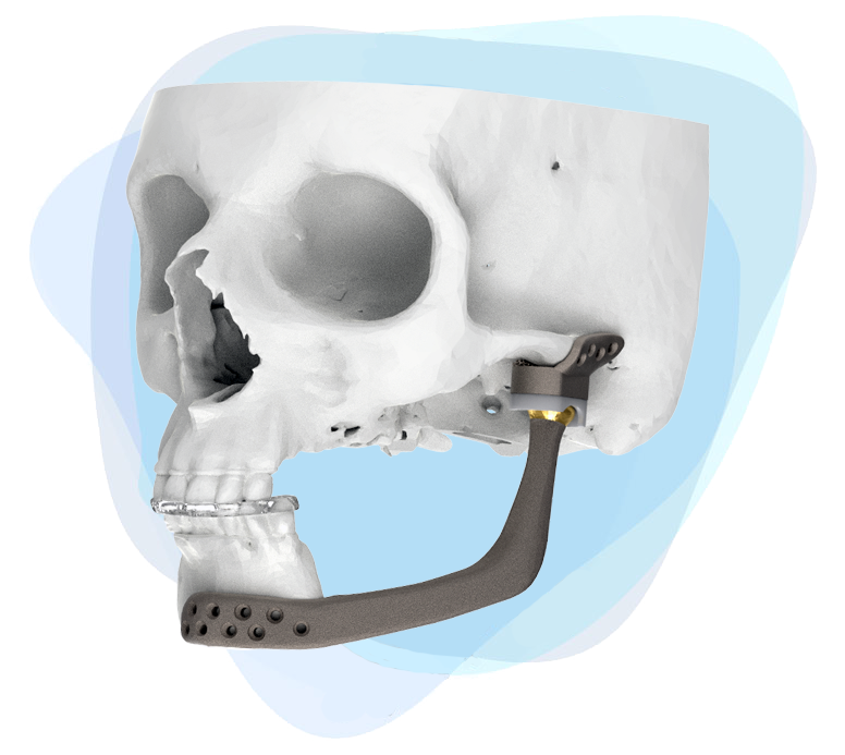 Reconstrucción de la articulación temporo-mandibular (ATM)