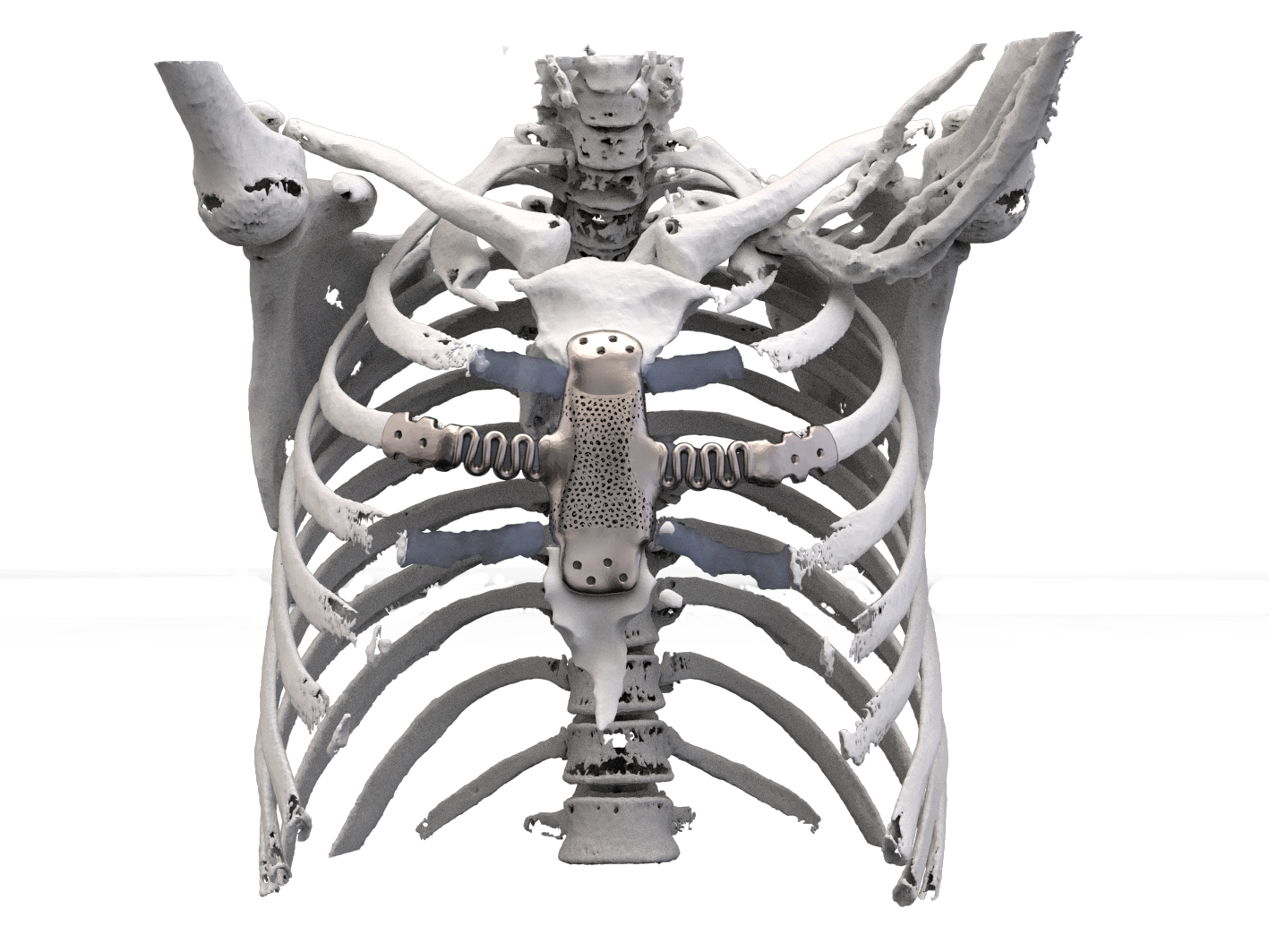 Titanium Rib Support Rib Implants Rib Cartilage Rhinoplasty: Pros And Cons | Miami, FL